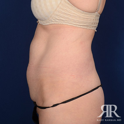 Tummy Tuck