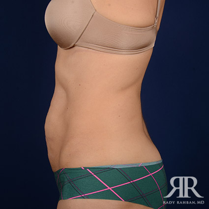 Tummy Tuck