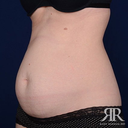 Tummy Tuck