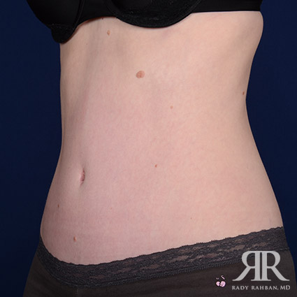 Tummy Tuck