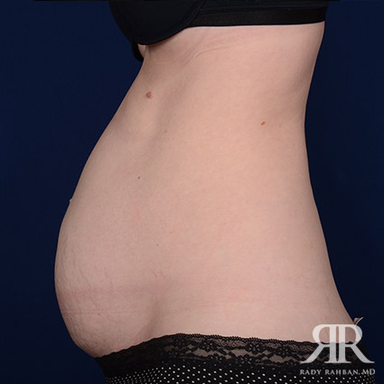 Tummy Tuck