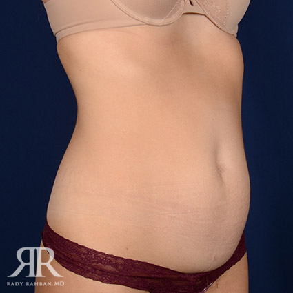 Tummy Tuck