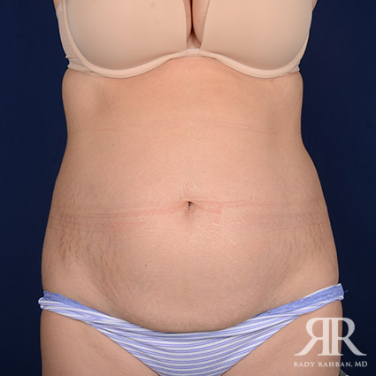 Tummy Tuck