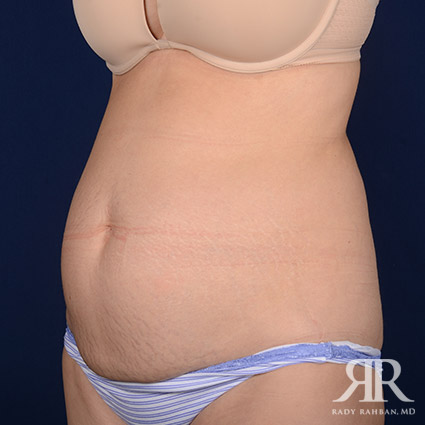 Tummy Tuck