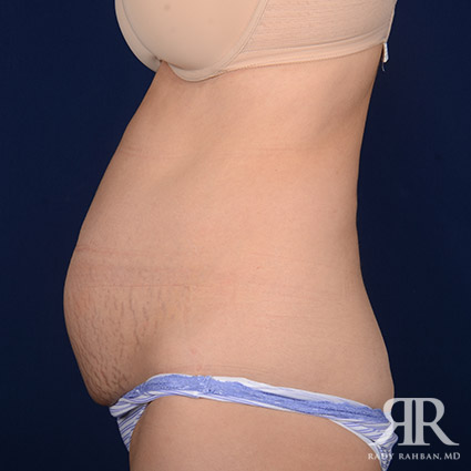 Tummy Tuck