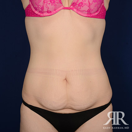 Tummy Tuck