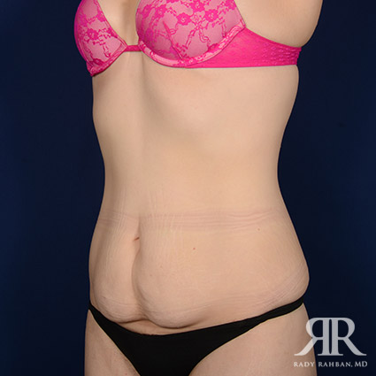 Tummy Tuck