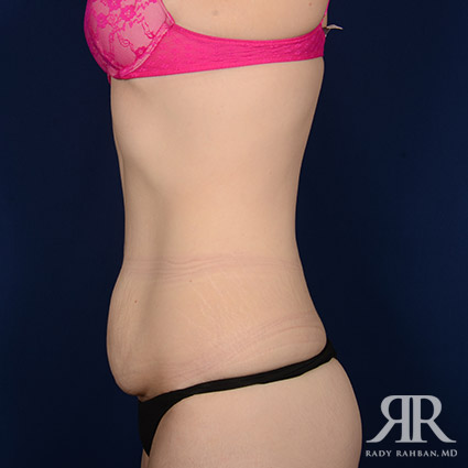 Tummy Tuck