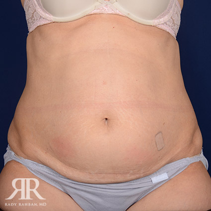 Tummy Tuck