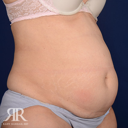 Tummy Tuck