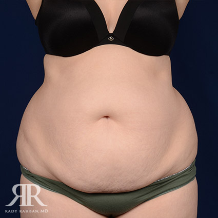 Tummy Tuck