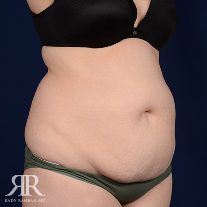 Tummy Tuck