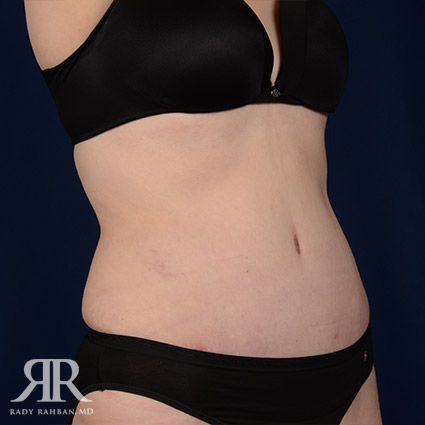 Tummy Tuck