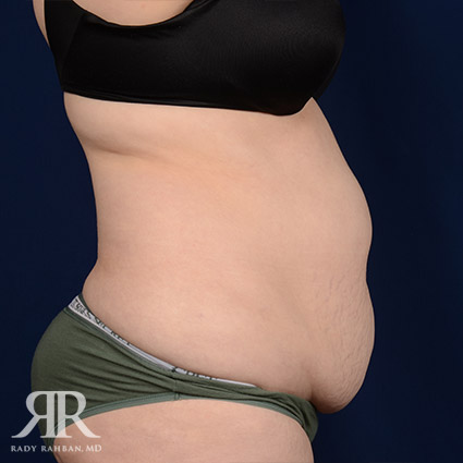 Tummy Tuck