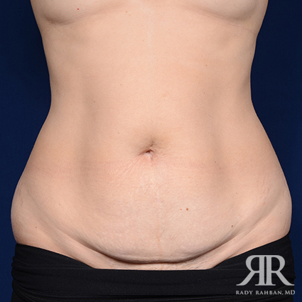 Tummy Tuck