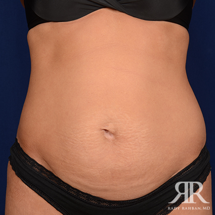 Tummy Tuck