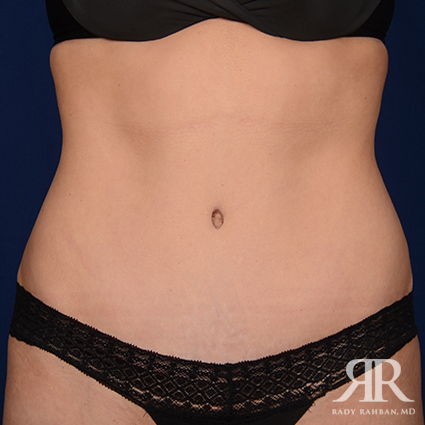 Tummy Tuck