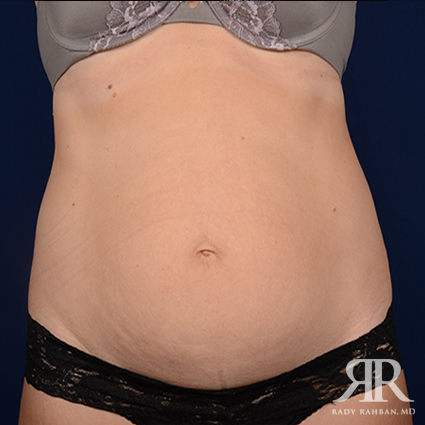 Tummy Tuck