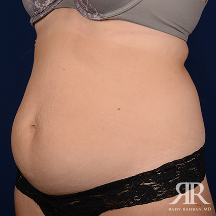 Tummy Tuck