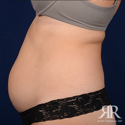 Tummy Tuck