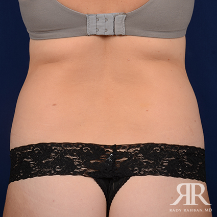 Tummy Tuck