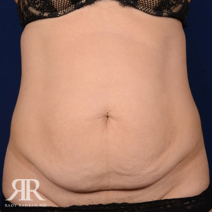 Tummy Tuck