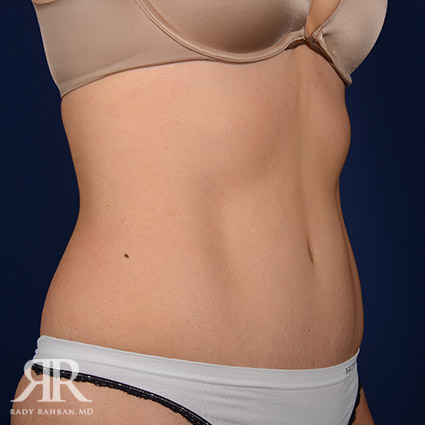 Tummy Tuck