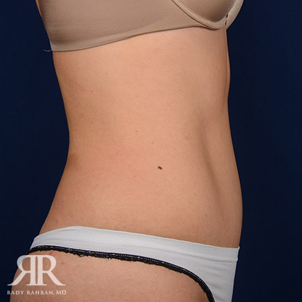 Tummy Tuck