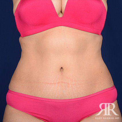 Tummy Tuck