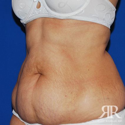 Tummy Tuck