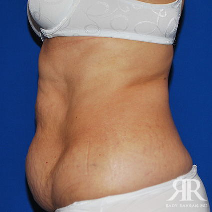 Tummy Tuck