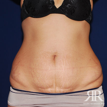 Tummy Tuck