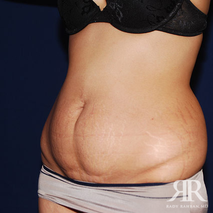 Tummy Tuck