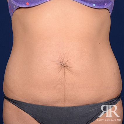 Tummy Tuck