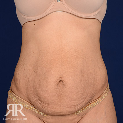 Tummy Tuck