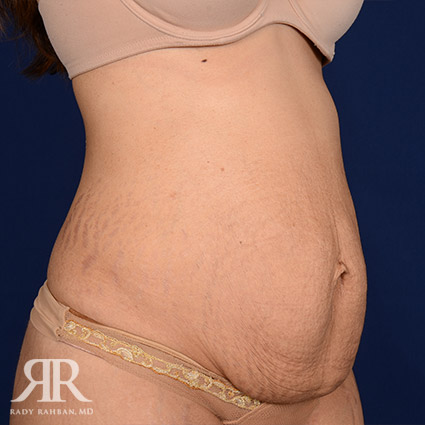 Tummy Tuck