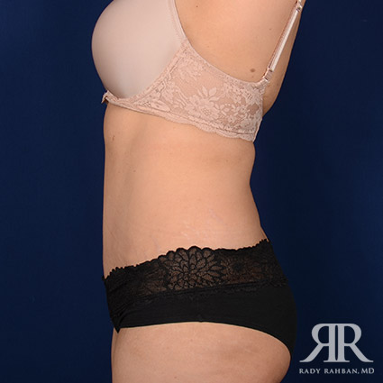 Tummy Tuck