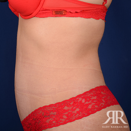 Tummy Tuck