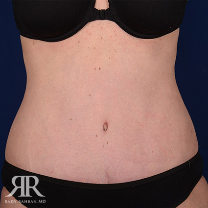 Tummy Tuck