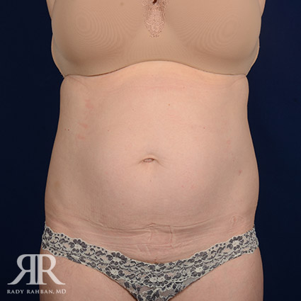 Tummy Tuck