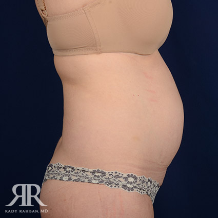 Tummy Tuck