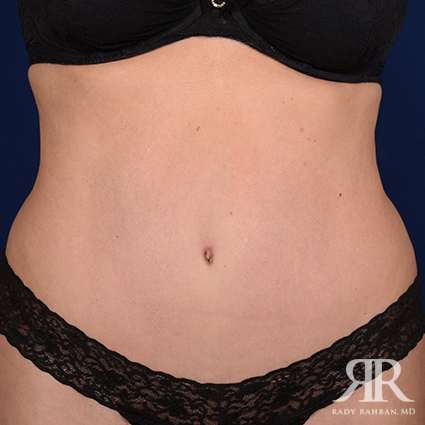 Tummy Tuck