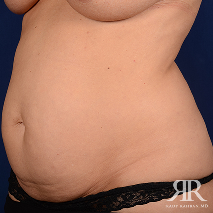 Tummy Tuck