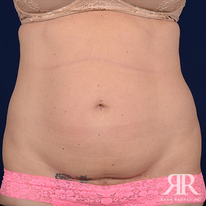 Tummy Tuck