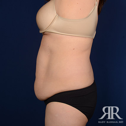 Tummy Tuck