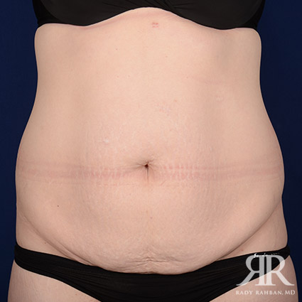 Tummy Tuck