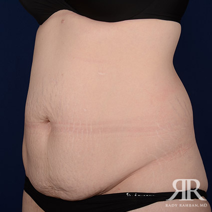 Tummy Tuck