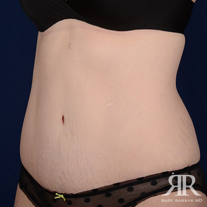 Tummy Tuck