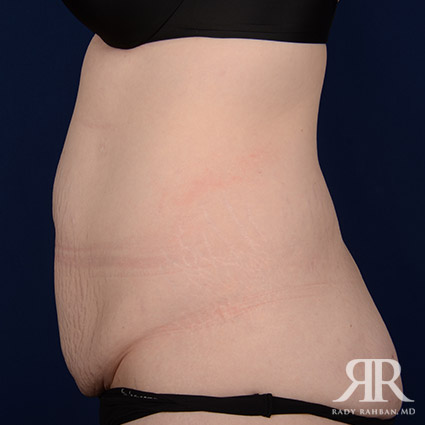 Tummy Tuck