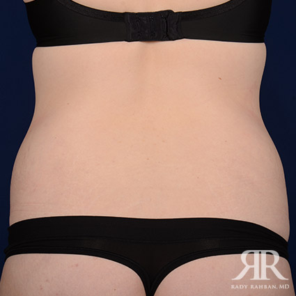 Tummy Tuck